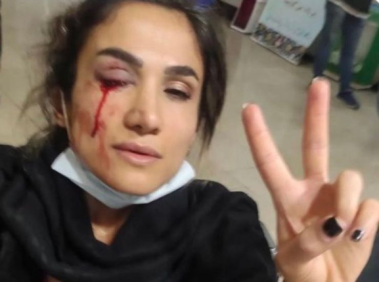 Una giovane che ha subito la repressione in Iran. Donne, giovani e uomini protestano da 3 mesi