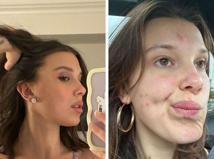 Millie Bobby Brown acne