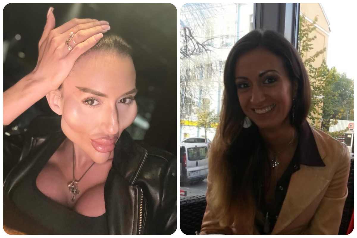 Donna irriconoscibile, le labbra più grandi del mondo