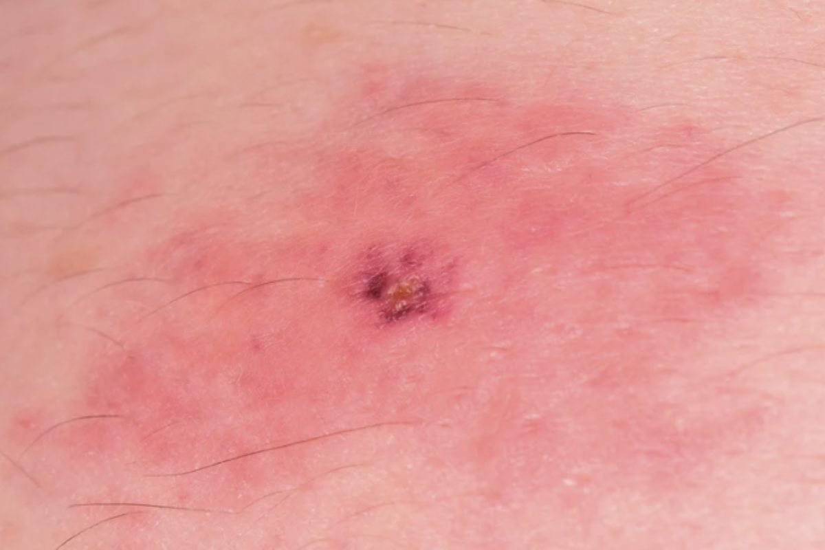 Negli ultimi anni, sono stati documentati casi estremamente gravi di persone che, colpite da questa allergia, hanno subito reazioni fatali.